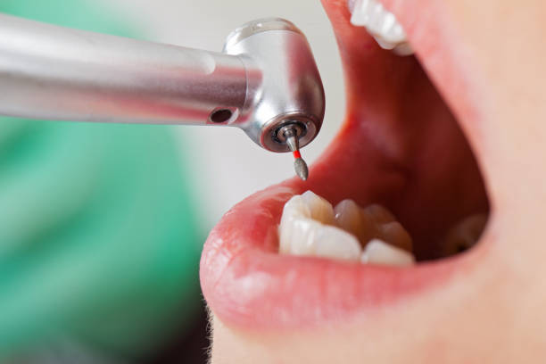 Best Knocked-Out Tooth (Avulsed Tooth) Treatment in Bright, IN